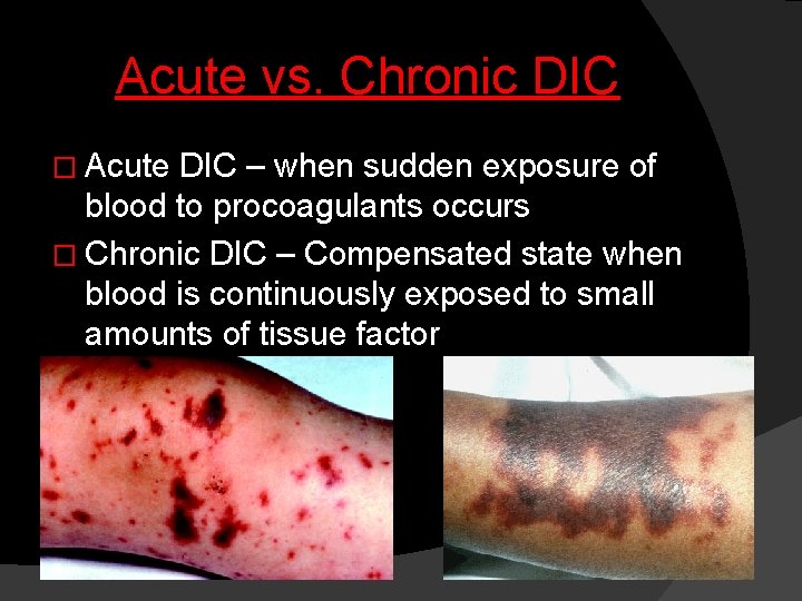 Acute vs. Chronic DIC � Acute DIC – when sudden exposure of blood to