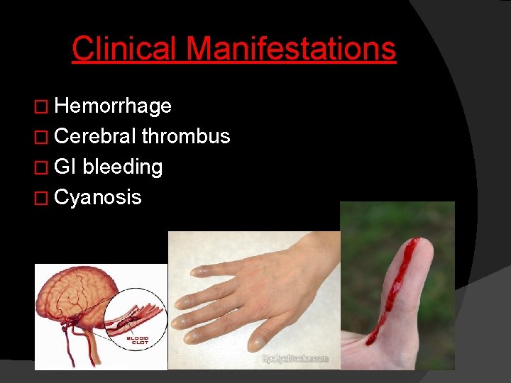 Clinical Manifestations � Hemorrhage � Cerebral thrombus � GI bleeding � Cyanosis 