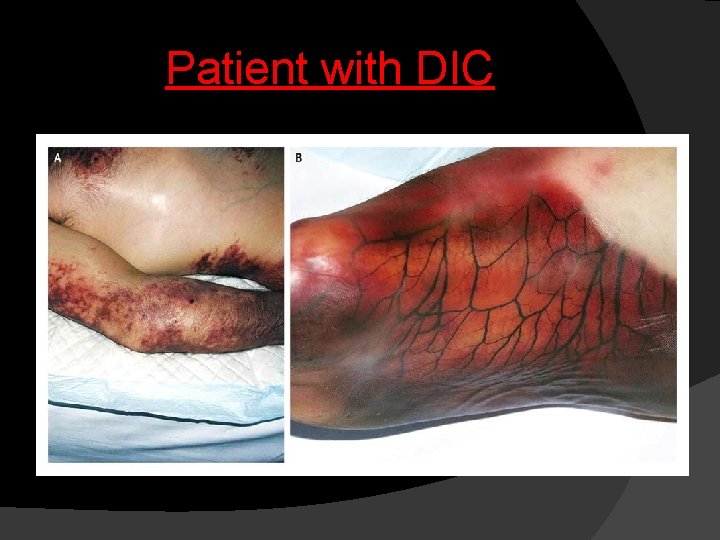 Patient with DIC 