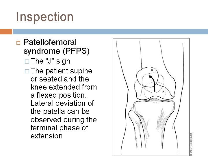 Inspection Patellofemoral syndrome (PFPS) � The “J” sign � The patient supine or seated