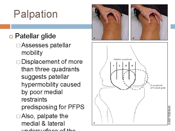 Palpation Patellar glide � Assesses patellar mobility � Displacement of more than three quadrants