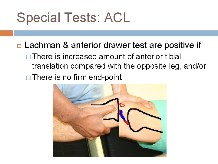 Special Tests: ACL Lachman & anterior drawer test are positive if � There is