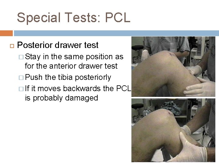 Special Tests: PCL Posterior drawer test � Stay in the same position as for