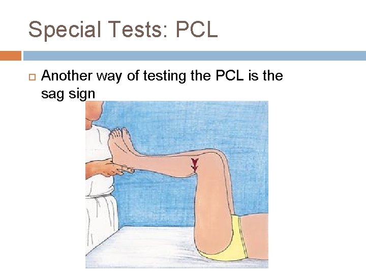 Special Tests: PCL Another way of testing the PCL is the sag sign 