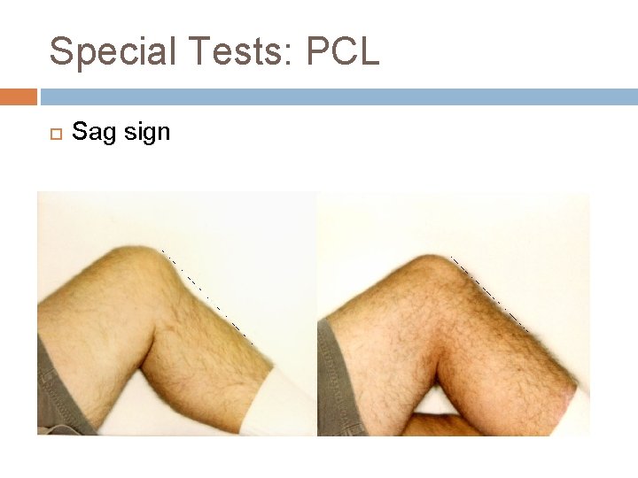 Special Tests: PCL Sag sign 