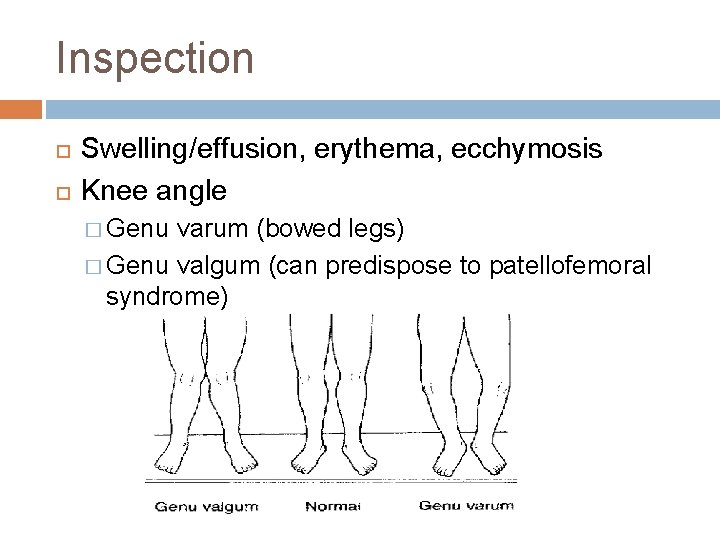 Inspection Swelling/effusion, erythema, ecchymosis Knee angle � Genu varum (bowed legs) � Genu valgum