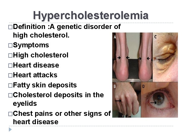 Hypercholesterolemia �Definition : A genetic disorder of high cholesterol. �Symptoms �High cholesterol �Heart disease