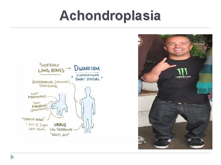 Achondroplasia 