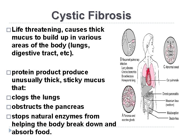 Cystic Fibrosis � Life threatening, causes thick mucus to build up in various areas