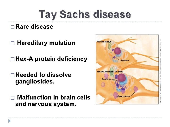 Tay Sachs disease � Rare disease � Hereditary mutation � Hex-A protein deficiency �