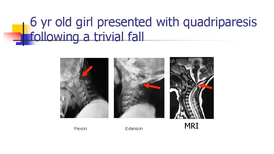 6 yr old girl presented with quadriparesis following a trivial fall Flexion Extension MRI 6 yr old girl presented with quadriparesis following a trivial fall Flexion Extension MRI