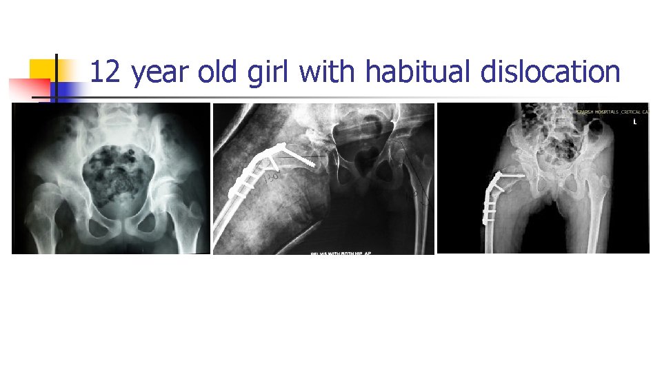 12 year old girl with habitual dislocation 12 year old girl with habitual dislocation