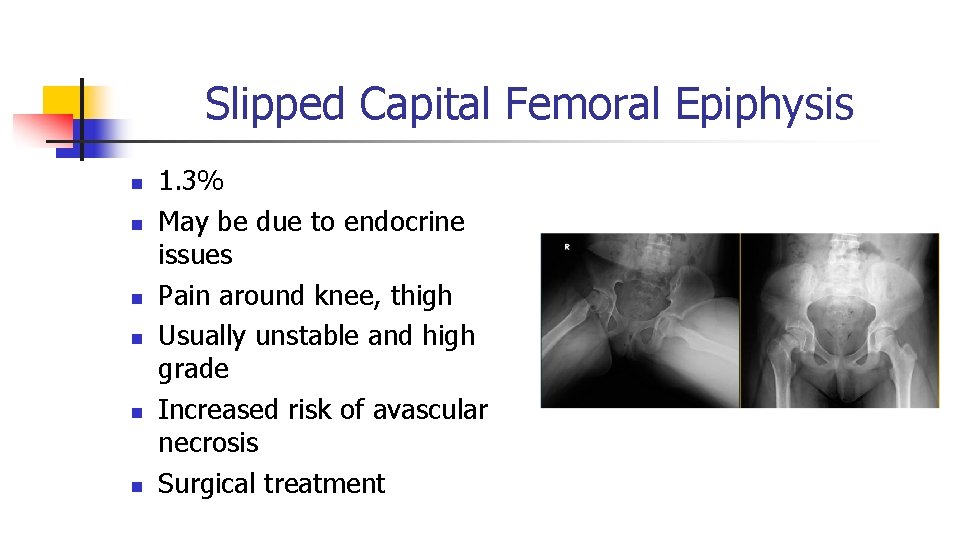 Slipped Capital Femoral Epiphysis n n n 1. 3% May be due to endocrine Slipped Capital Femoral Epiphysis n n n 1. 3% May be due to endocrine