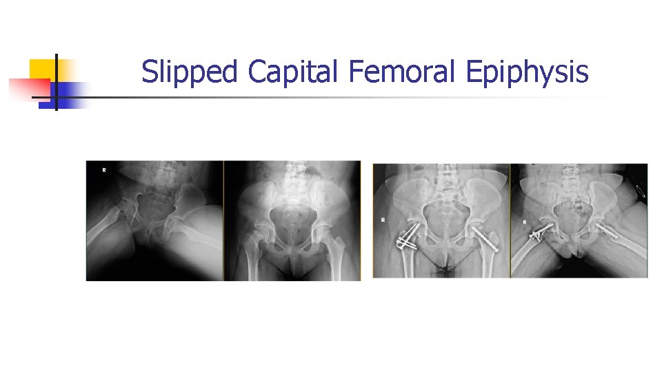 Slipped Capital Femoral Epiphysis Slipped Capital Femoral Epiphysis