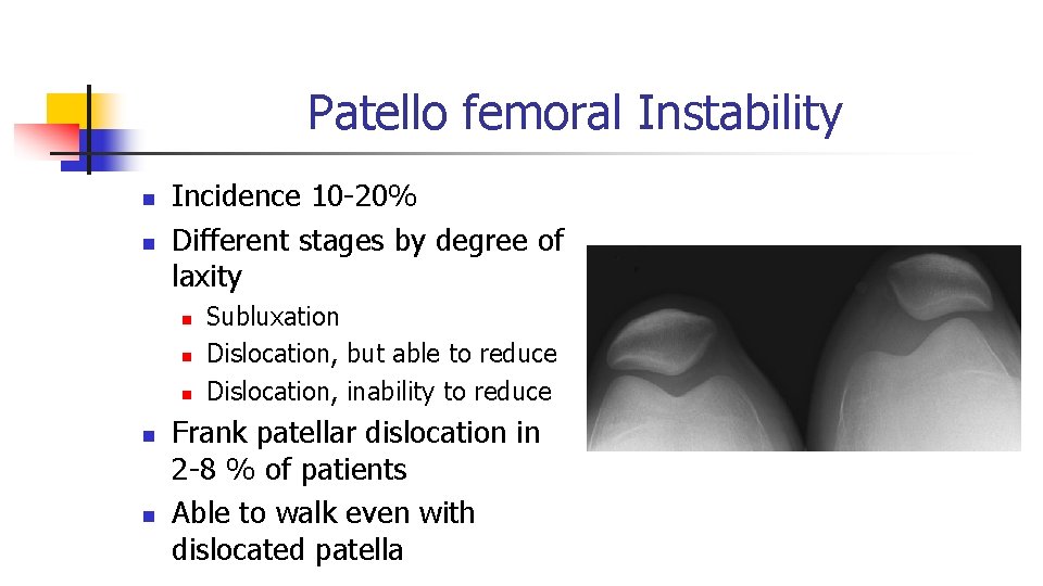 Patello femoral Instability n n Incidence 10 -20% Different stages by degree of laxity Patello femoral Instability n n Incidence 10 -20% Different stages by degree of laxity