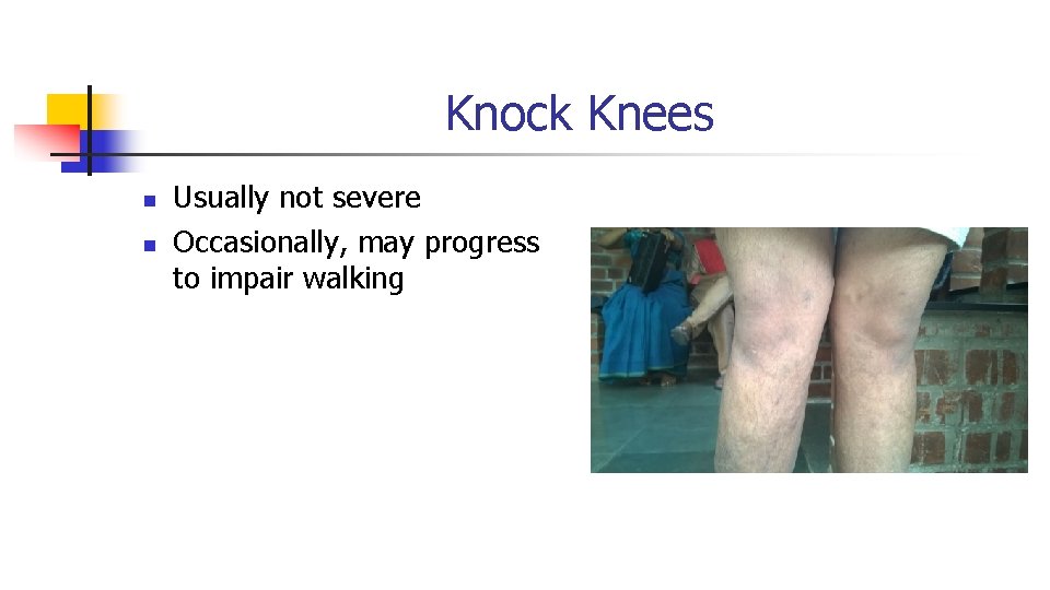 Knock Knees n n Usually not severe Occasionally, may progress to impair walking Knock Knees n n Usually not severe Occasionally, may progress to impair walking