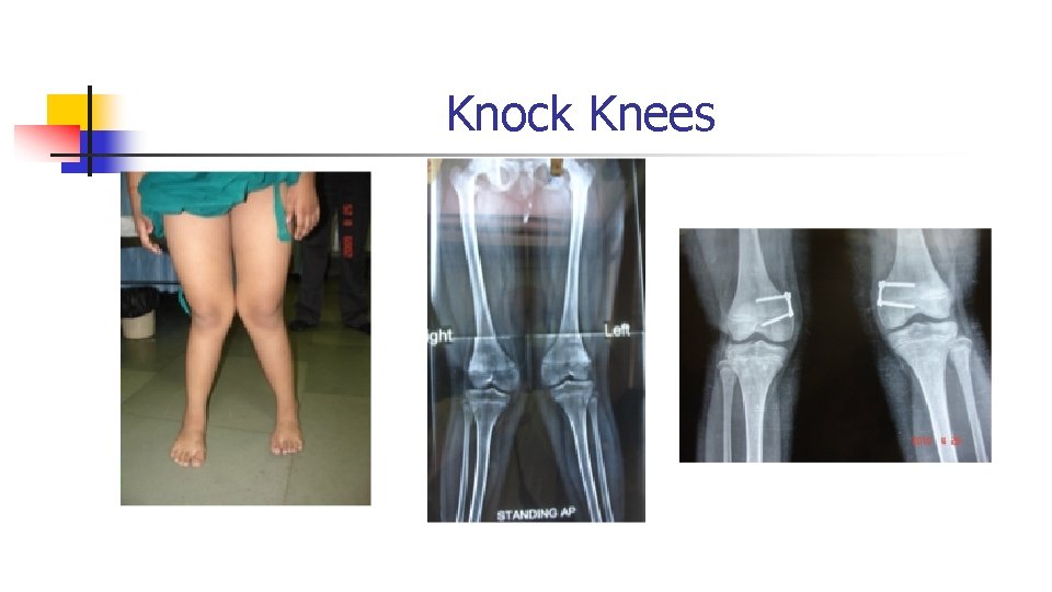 Knock Knees Knock Knees