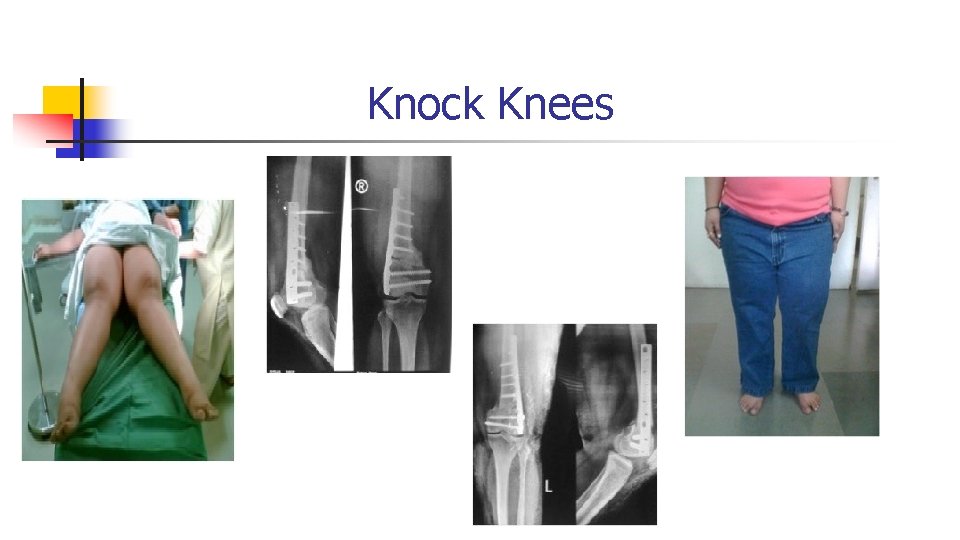 Knock Knees Knock Knees