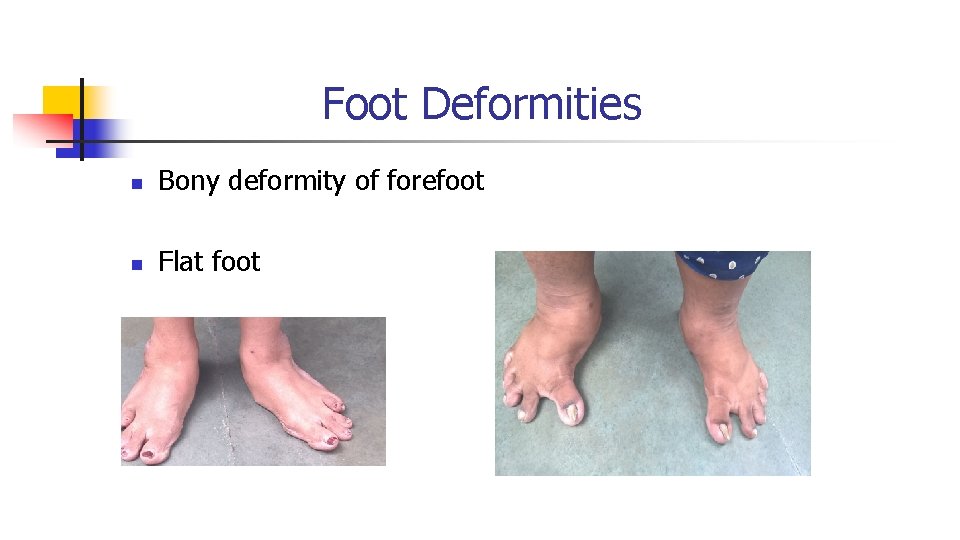 Foot Deformities n Bony deformity of forefoot n Flat foot Foot Deformities n Bony deformity of forefoot n Flat foot
