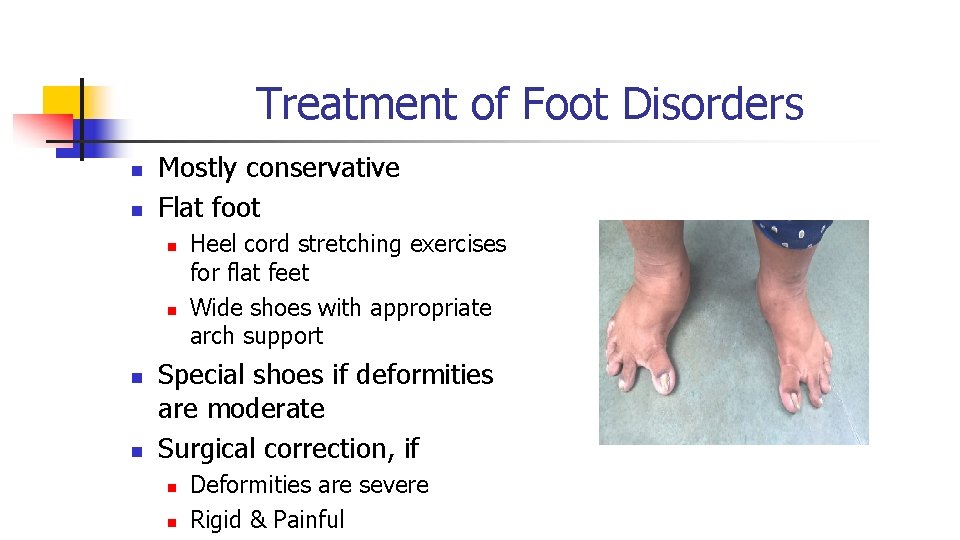 Treatment of Foot Disorders n n Mostly conservative Flat foot n n Heel cord Treatment of Foot Disorders n n Mostly conservative Flat foot n n Heel cord