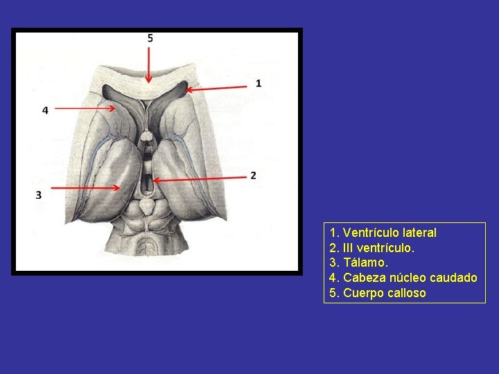 1. Ventrículo lateral 2. III ventrículo. 3. Tálamo. 4. Cabeza núcleo caudado 5. Cuerpo