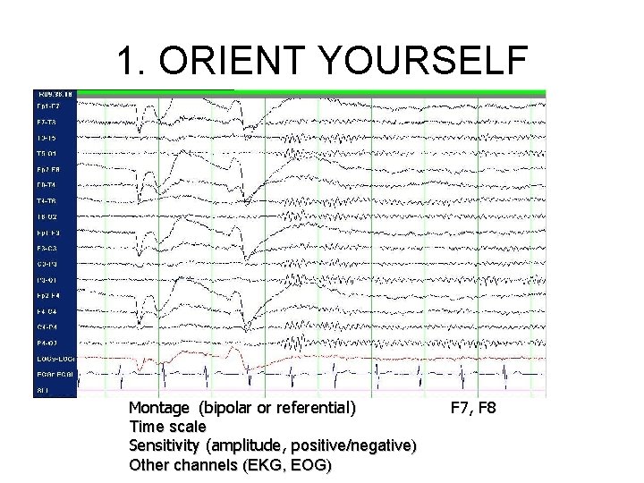 1. ORIENT YOURSELF Montage (bipolar or referential) Time scale Sensitivity (amplitude, positive/negative) Other channels 1. ORIENT YOURSELF Montage (bipolar or referential) Time scale Sensitivity (amplitude, positive/negative) Other channels