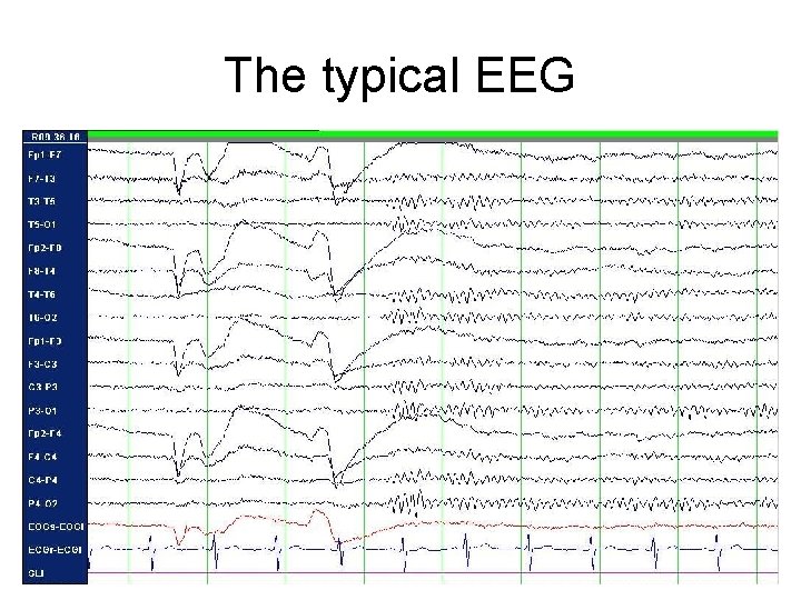 The typical EEG The typical EEG