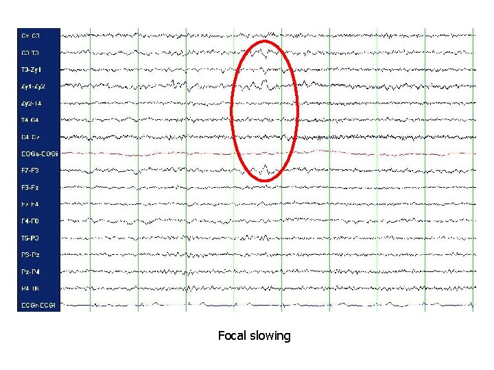 Focal slowing 