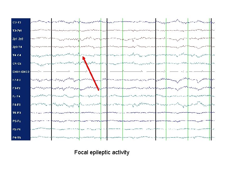 Focal epileptic activity 