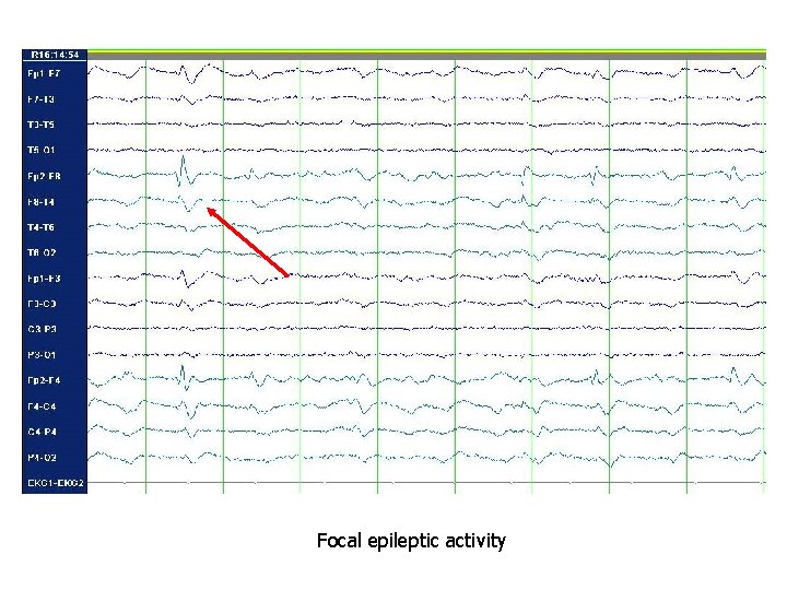 Focal epileptic activity Focal epileptic activity