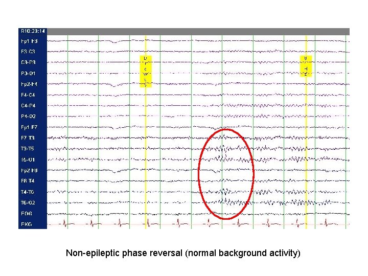 Non-epileptic phase reversal (normal background activity) Non-epileptic phase reversal (normal background activity)