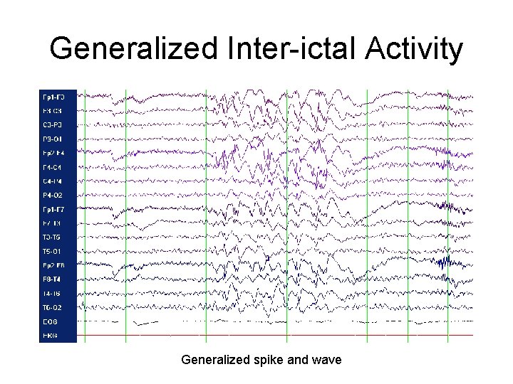 Generalized Inter-ictal Activity Generalized spike and wave Generalized Inter-ictal Activity Generalized spike and wave