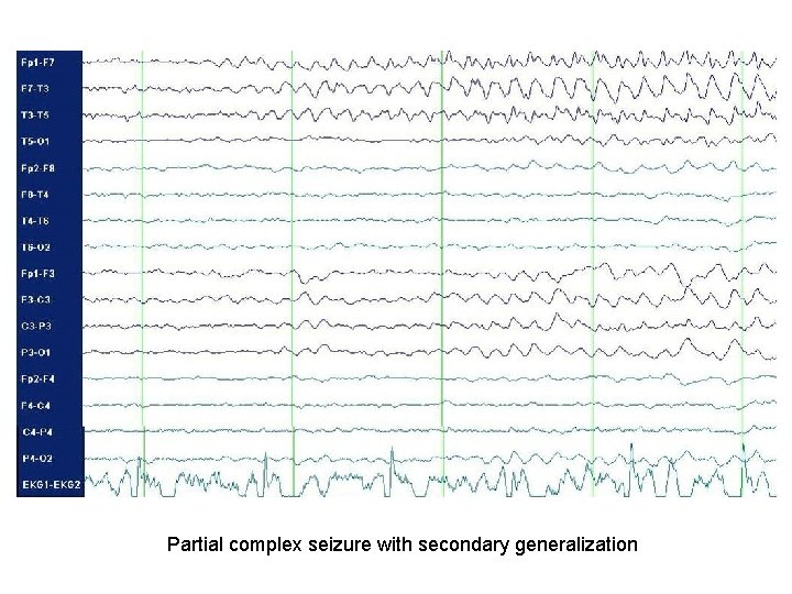 Partial complex seizure with secondary generalization Partial complex seizure with secondary generalization