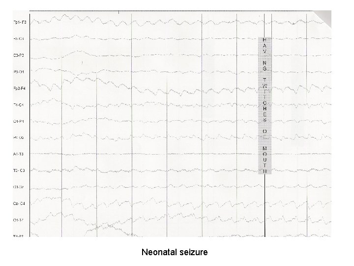 Neonatal seizure Neonatal seizure