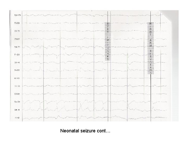 Neonatal seizure cont… 