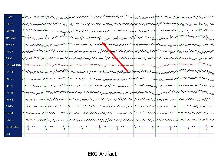 EKG Artifact 