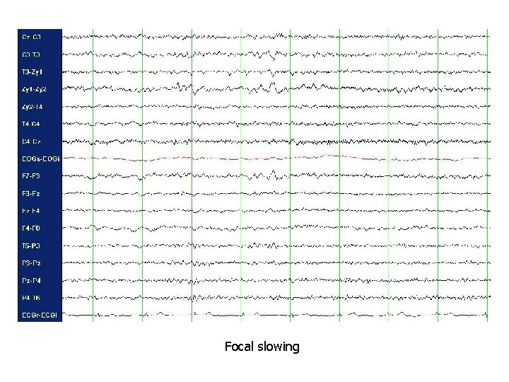 Focal slowing 