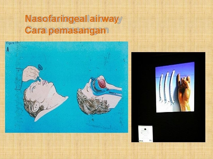 Nasofaringeal airway Cara pemasangan 