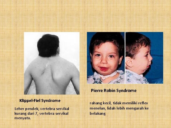 Pierre Robin Syndrome Klippel-Fiel Syndrome Leher pendek, vertebra servikal kurang dari 7, vertebra servikal