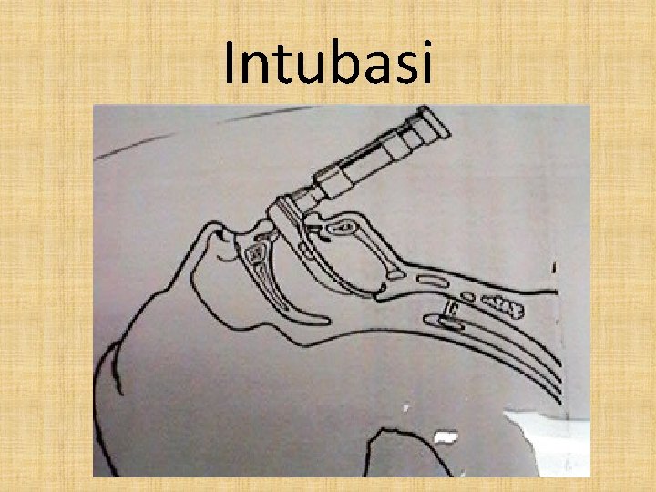 Intubasi 