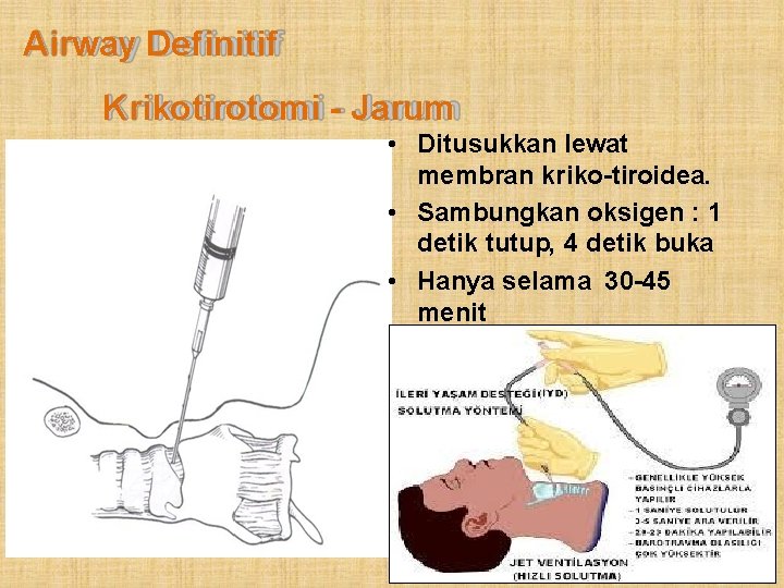 Airway Definitif Krikotirotomi - Jarum • Ditusukkan lewat membran kriko-tiroidea. • Sambungkan oksigen :