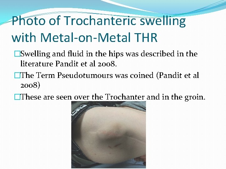 Photo of Trochanteric swelling with Metal-on-Metal THR �Swelling and fluid in the hips was