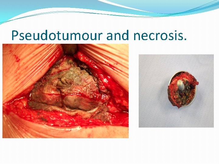 Pseudotumour and necrosis. 