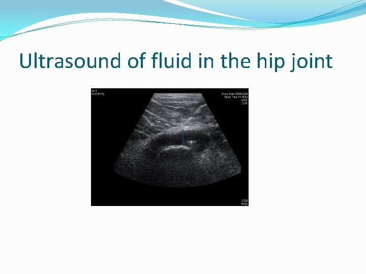 Ultrasound of fluid in the hip joint 