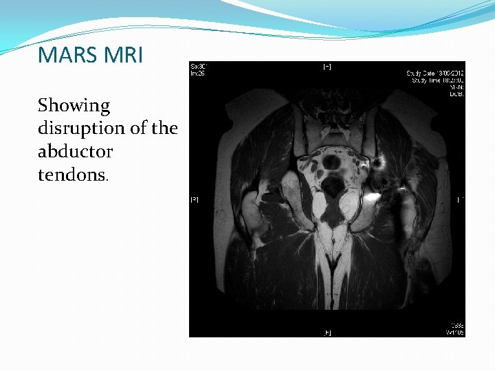 MARS MRI Showing disruption of the abductor tendons. 