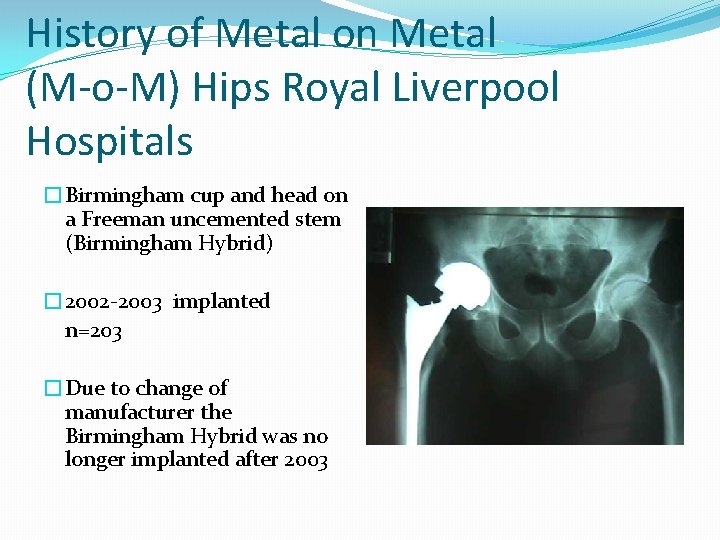 History of Metal on Metal (M-o-M) Hips Royal Liverpool Hospitals �Birmingham cup and head