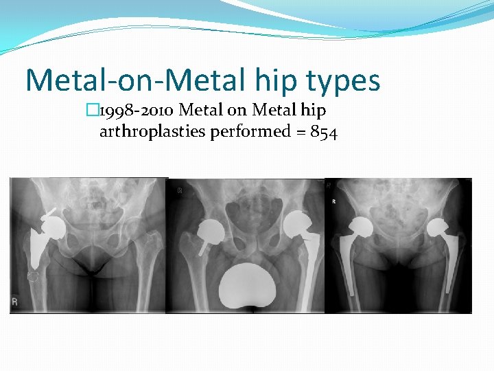 Metal-on-Metal hip types � 1998 -2010 Metal on Metal hip arthroplasties performed = 854