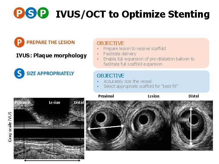 P S P IVUS/OCT to Optimize Stenting OBJECTIVE IVUS: Plaque morphology • • •