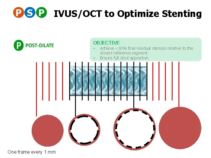 P S P IVUS/OCT to Optimize Stenting OBJECTIVE • • One frame every 1