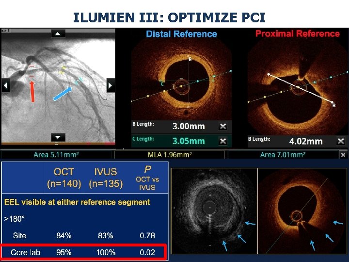 ILUMIEN III: OPTIMIZE PCI 